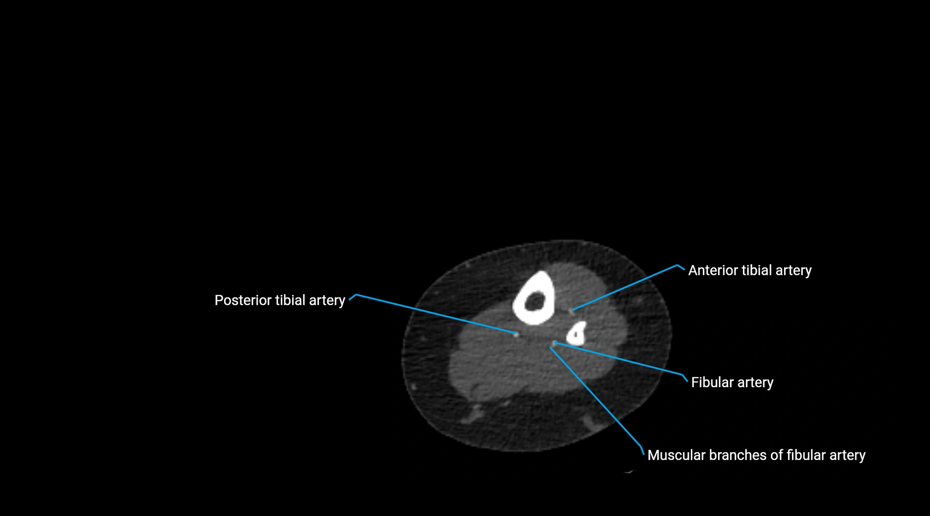 CTA lower limb cross sectional anatomy labelled image _220.webp